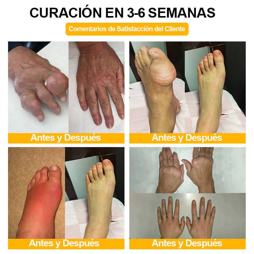 Ropceer™ Toxina Botulínica & Veneno de Abeja Alivio del Dolor Crema Cicatrizante de Huesos